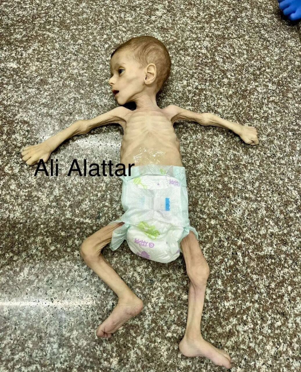 Baby in Gaza dies of malnutrition